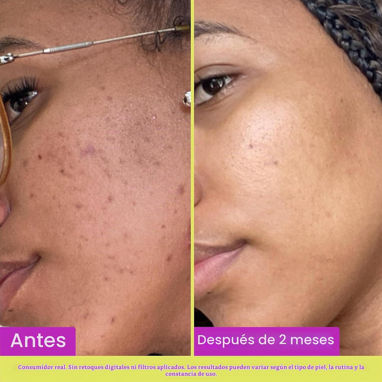 GOOD MOLECULES TRATAMIENTO DE 10% DE ÁCIDO AZELAICO PARA LA CARA FÓRMULA CALMANTE PARA EL ENROJECIMIENTO FACIAL Y EL TONO - 5