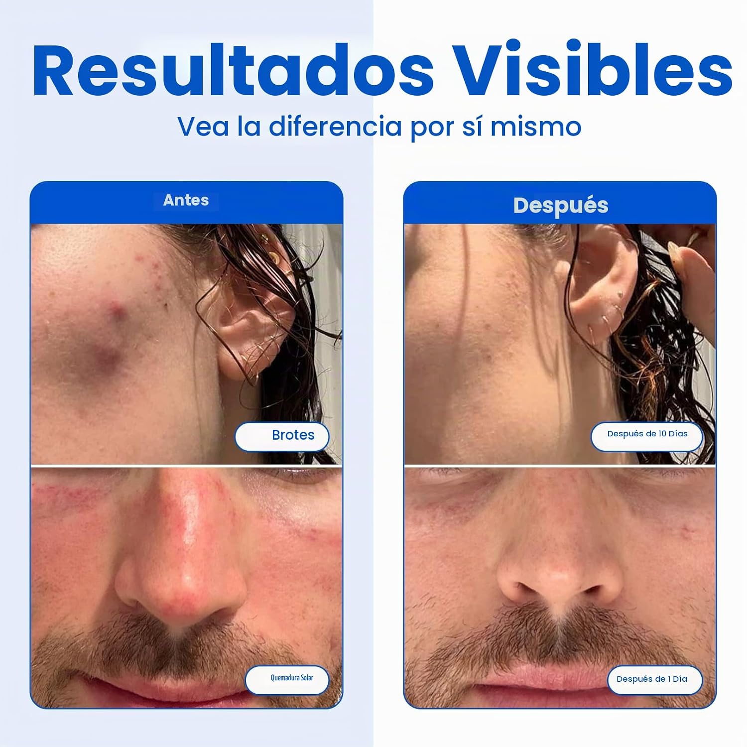 MAGIC MOLECULE SPRAY DE ÁCIDO HIPOCLOROSO PARA PIEL PROPENSA A BROTES, ECCEMA Y ERUPCIONES CON PICAZÓN AYUDA A MÁS DE 50 - 3