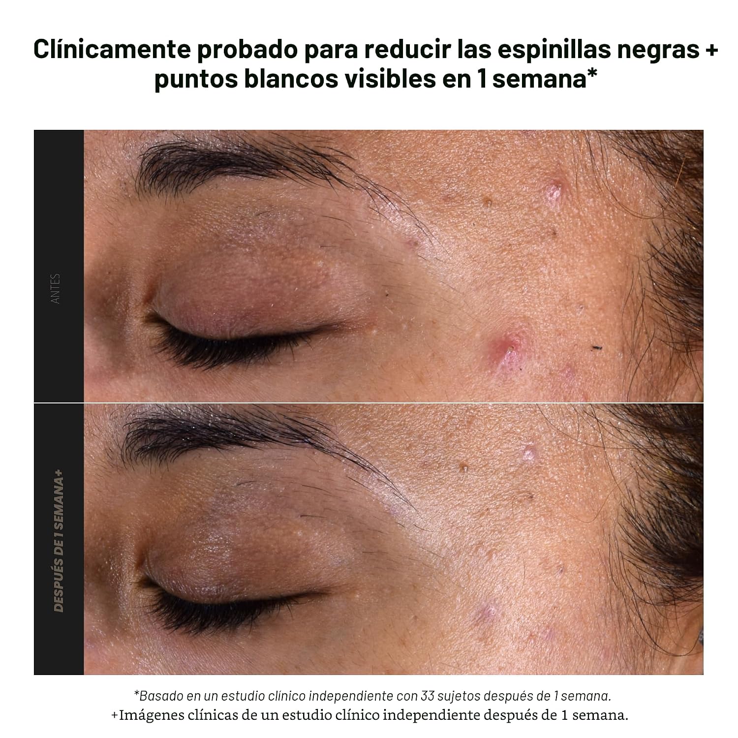 PAULA S CHOICE SKIN PERFECTING 2% BHA SALICYLIC ACID EXFOLIATING PADS - FACIAL EXFOLIANT PADS PARA BLACKHEADS, ENLARGED - 2