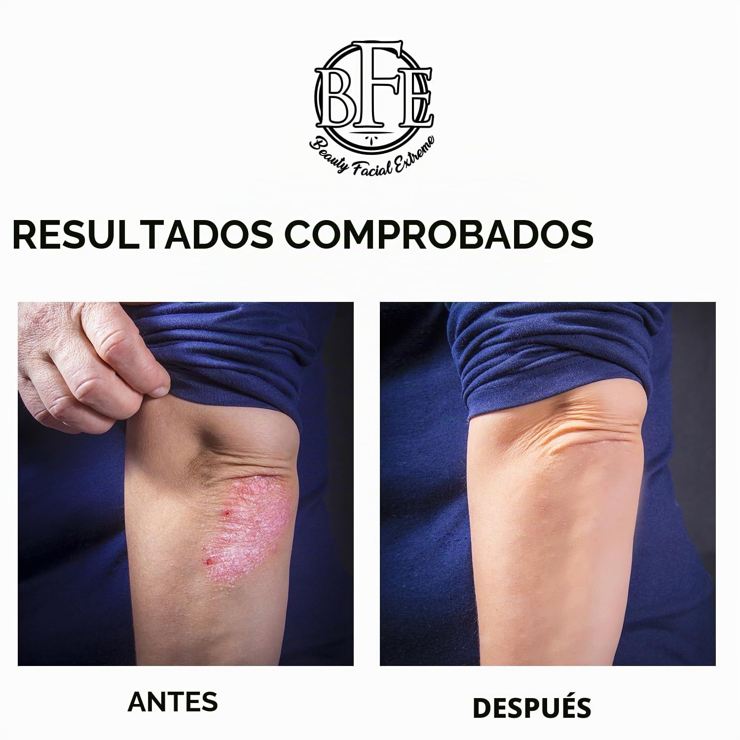 LOCIÓN CORPORAL EXFOLIANTE KERATOSIS PILARIS - 12% DE ÁCIDO LÁCTICO. PROPORCIONA HUMEDAD INMEDIATA Y EXFOLIACIÓN SUAVE - 3