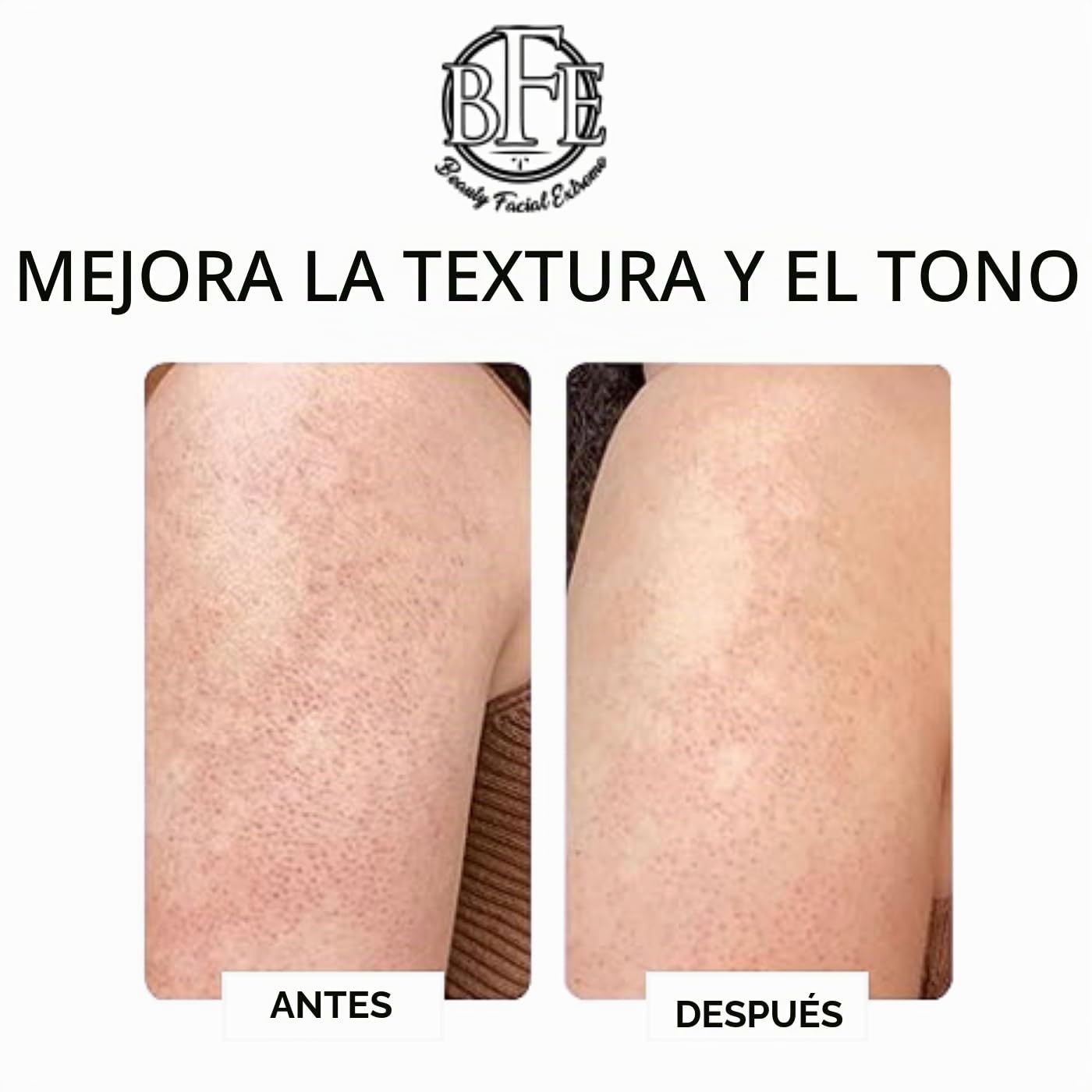 LOCIÓN CORPORAL EXFOLIANTE KERATOSIS PILARIS - 12% DE ÁCIDO LÁCTICO. PROPORCIONA HUMEDAD INMEDIATA Y EXFOLIACIÓN SUAVE - 5