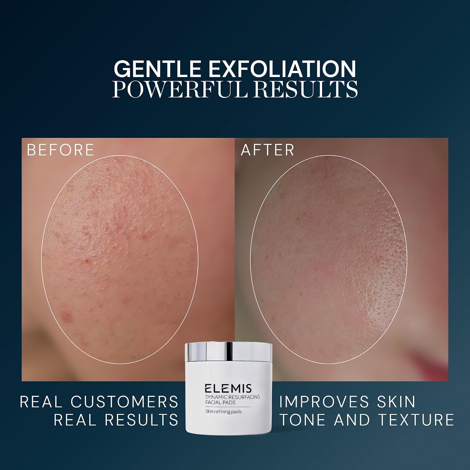 ELEMIS ALMOHADILLAS FACIALES DE RENOVACIÓN DINÁMICA, ALMOHADILLAS FACIALES EXFOLIANTES DE TRATAMIENTO CON TEXTURA SUAVE - 3