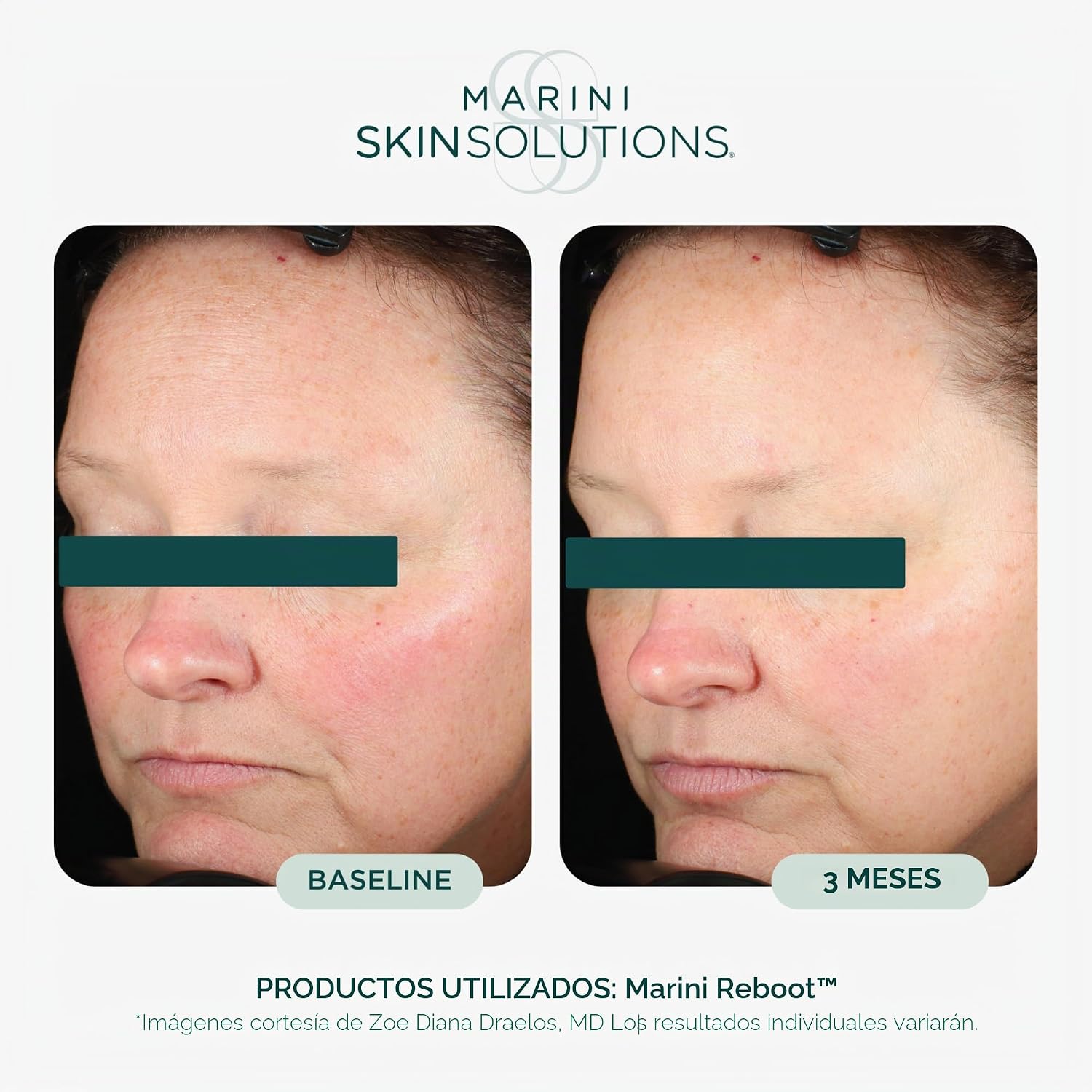 MARINI SKINSOLUTIONS MARINI REBOOT - SUERO FACIAL ANTIENVEJECIMIENTO PDRN - APOYA UNA PIEL VISIBLEMENTE MÁS SUAVE - 3