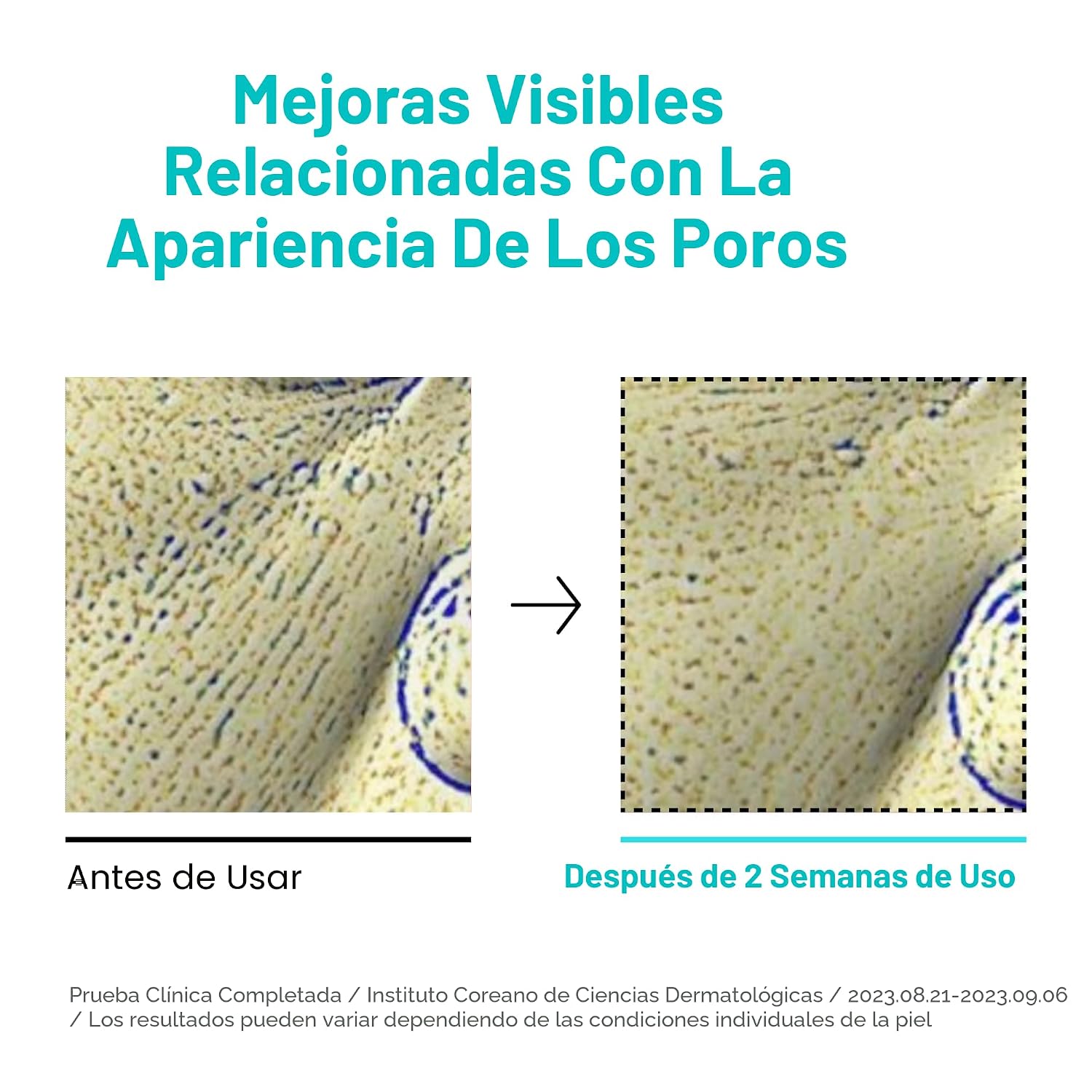 ANUA BHA 2% TÓNICO EXFOLIANTE SUAVE, EXFOLIANTE FACIAL SUAVE, ÁCIDO SALICÍLICO PARA POROS Y SEBUM, EXTRACTO DE ÁRBOL DEL TÉ, - 5