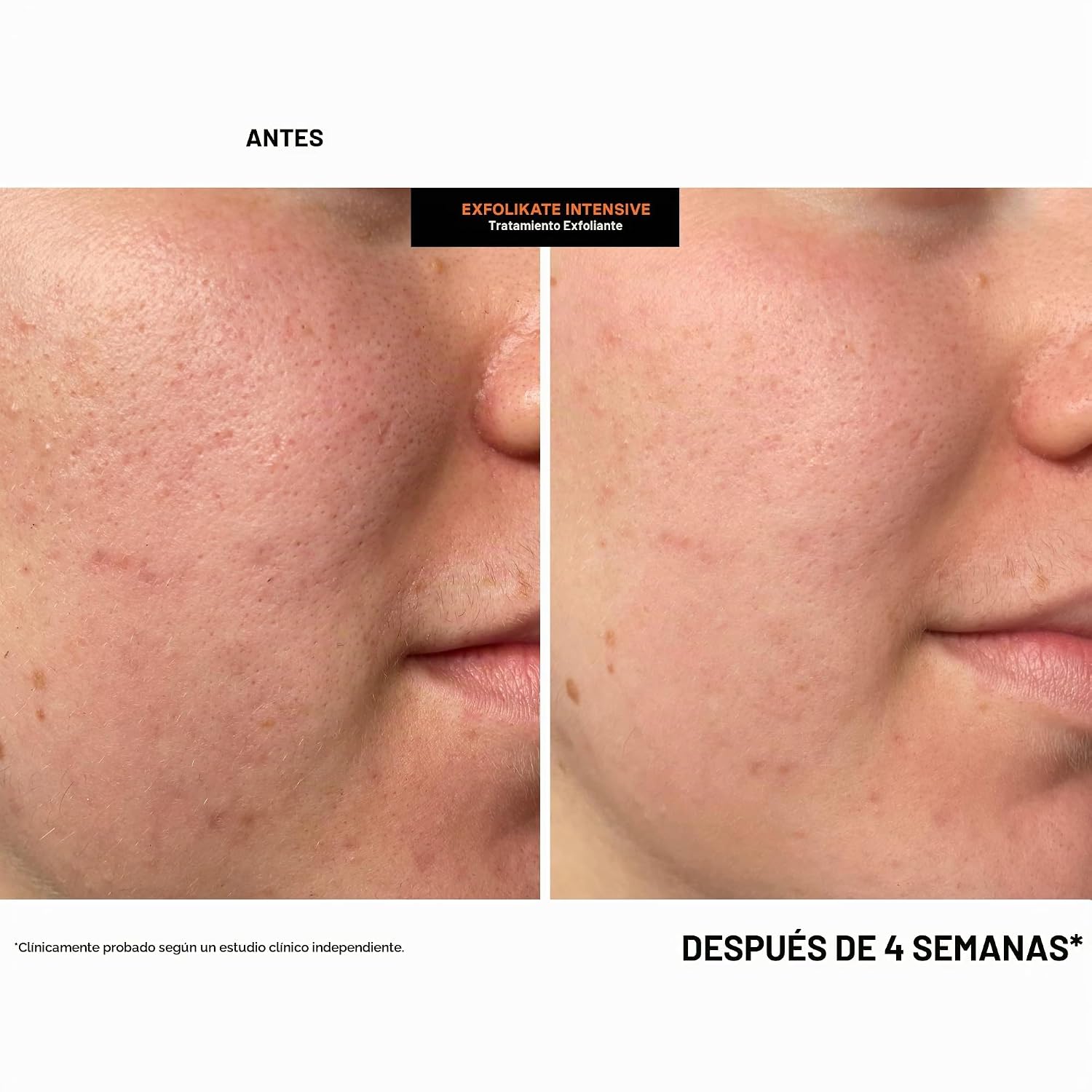 KATE SOMERVILLE EXFOLIKATE - TRATAMIENTO EXFOLIANTE INTENSIVO, 2 ONZAS LÍQUIDAS - 5