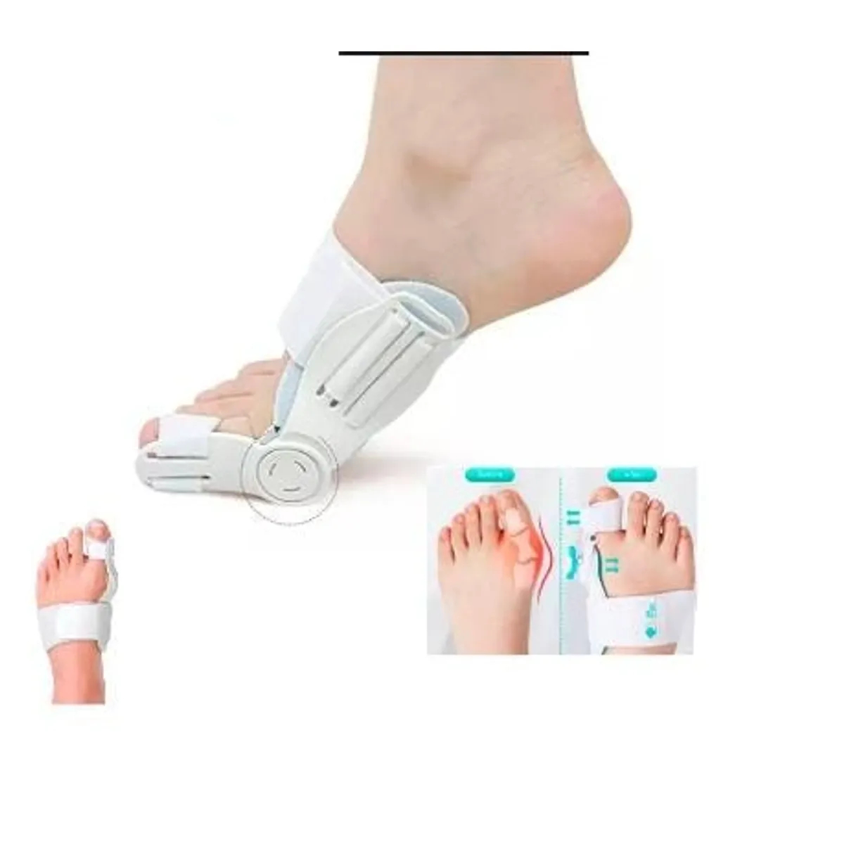 CORRECTOR DE JUANETE HALLUX VALGUS AJUSTABLE PARA PIE - 6