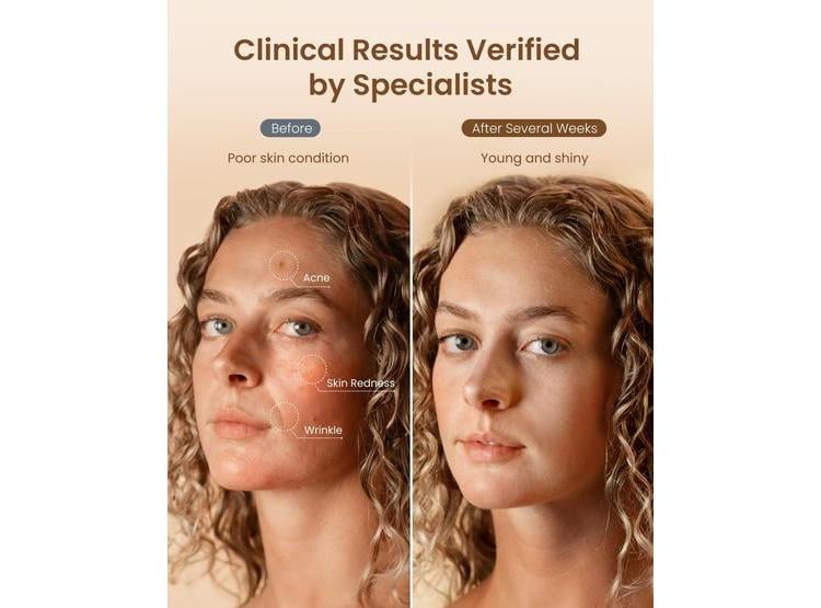 RENPHO MÁSCARA DE TERAPIA DE LUZ ROJA 4D PARA ROSTRO, CON 324 LEDS Y 3 MODOS DE LUZ, COBERTURA FACIAL COMPLETA - 3