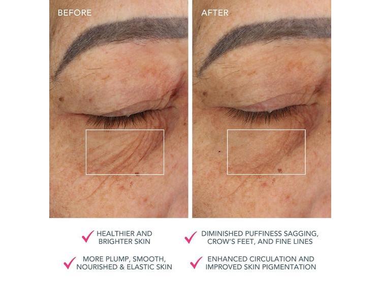 DISPOSITIVO FACIAL FOREO BEAR CON MICROCORRIENTE, LIFTING Y CONTORNO NO INVASIVO, ABSORCIÓN OPTIMIZADA, EN COLOR FUCSIA - 4
