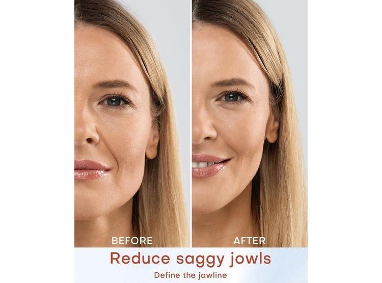 MLAY MÁQUINA DE BELLEZA RF, DISPOSITIVO PARA REDUCIR ARRUGAS Y ANTIENVEJECIMIENTO, USO EN CASA, EFECTOS DE SALÓN - 2