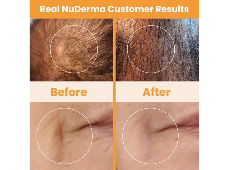 NUDERMA: MÁQUINA DE TERAPIA DE PIEL DE MANO CON NEÓN PARA ANTIENVEJECIMIENTO Y ESTIMULACIÓN DE CABELLO - 6