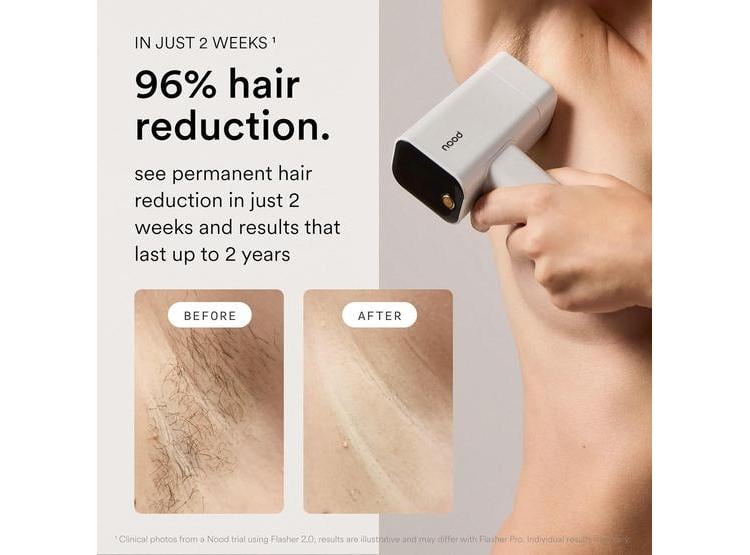NOOD FLASHER PRO: DEPILACIÓN LÁSER IPL Y TERAPIA ANTI-EDAD SEGURA PARA HOMBRES Y MUJERES, RESULTADOS VISIBLES AL INSTANTE - 2