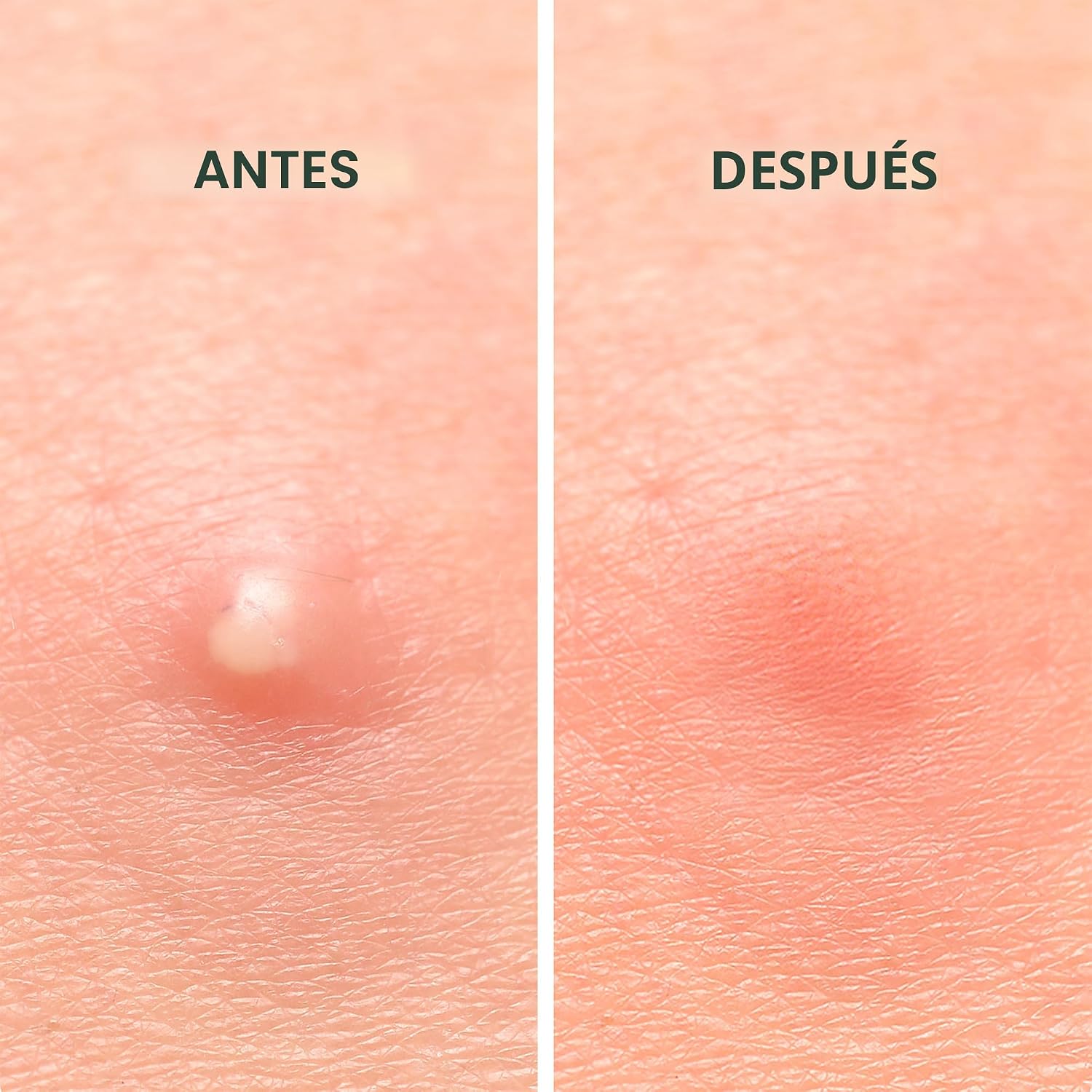 PARCHES HIDROCLOIDE RAEL MIRACLE INVISIBLE SPOT COVER ANTIACNÉ 96 UNIDADES - 5