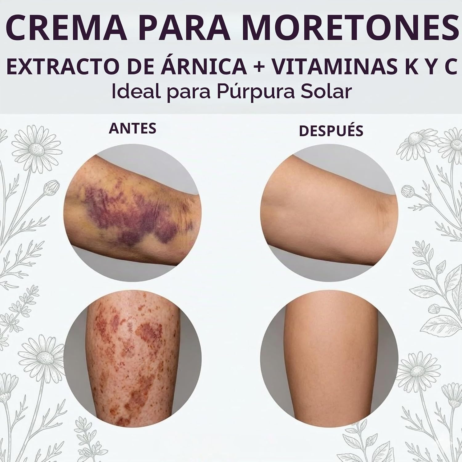 CREMA PARA MORETONES DERMARA CON ÁRNICA Y VITAMINA K, 4 OZ - 3