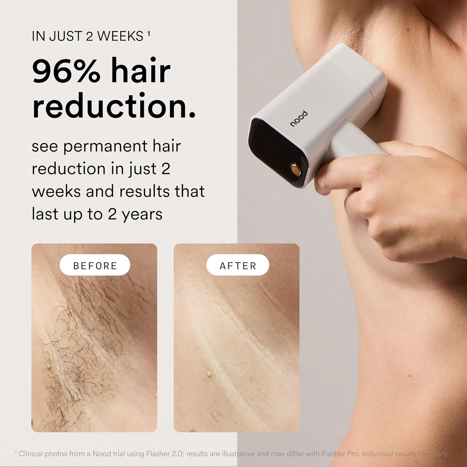 DISPOSITIVO IPL NOOD FLASHER PRO PARA DEPILACIÓN LÁSER EN CASA - 3