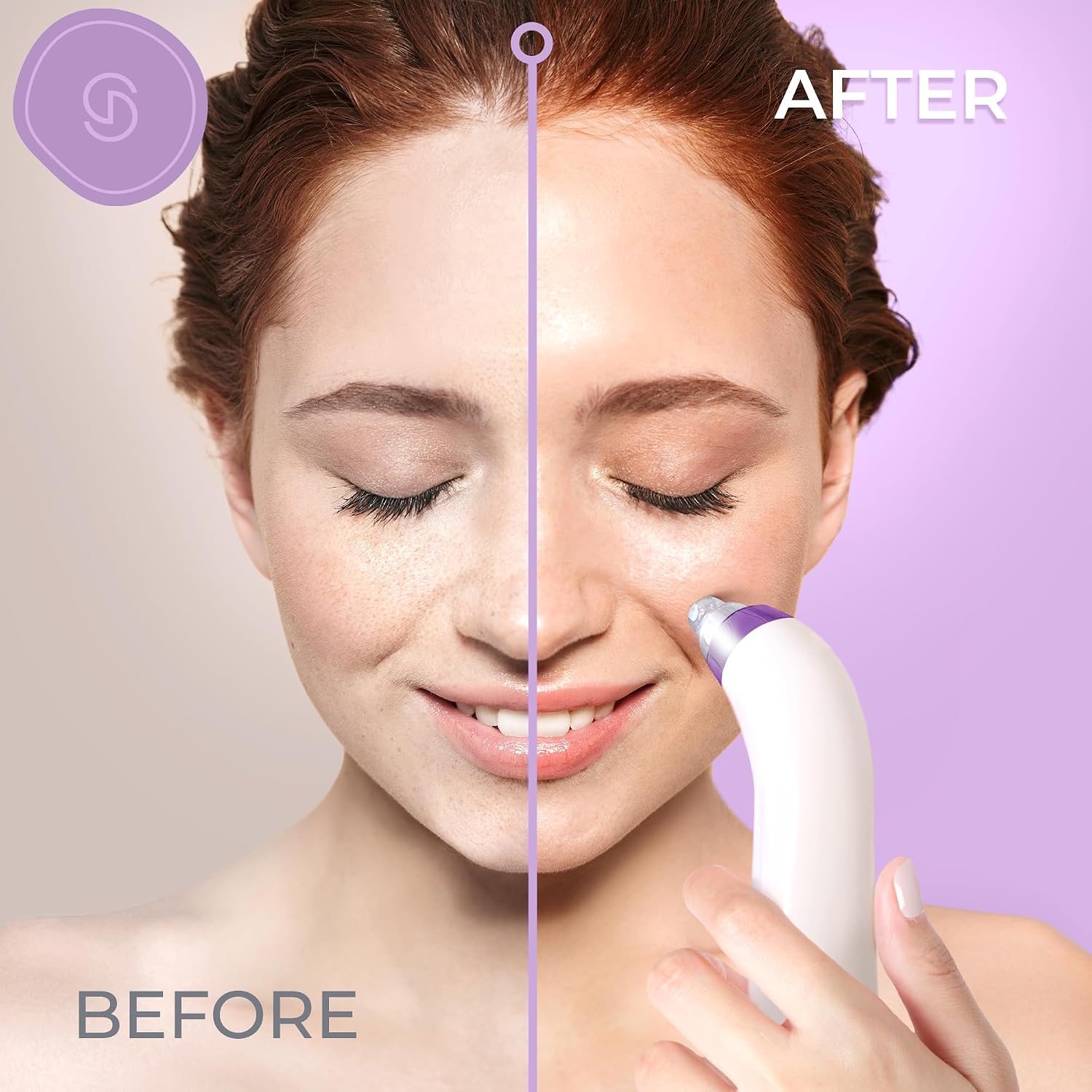 REMOVEDOR DE PUNTOS NEGROS ESSY MODELO BLACKHEAD REMOVER MORADO - 3