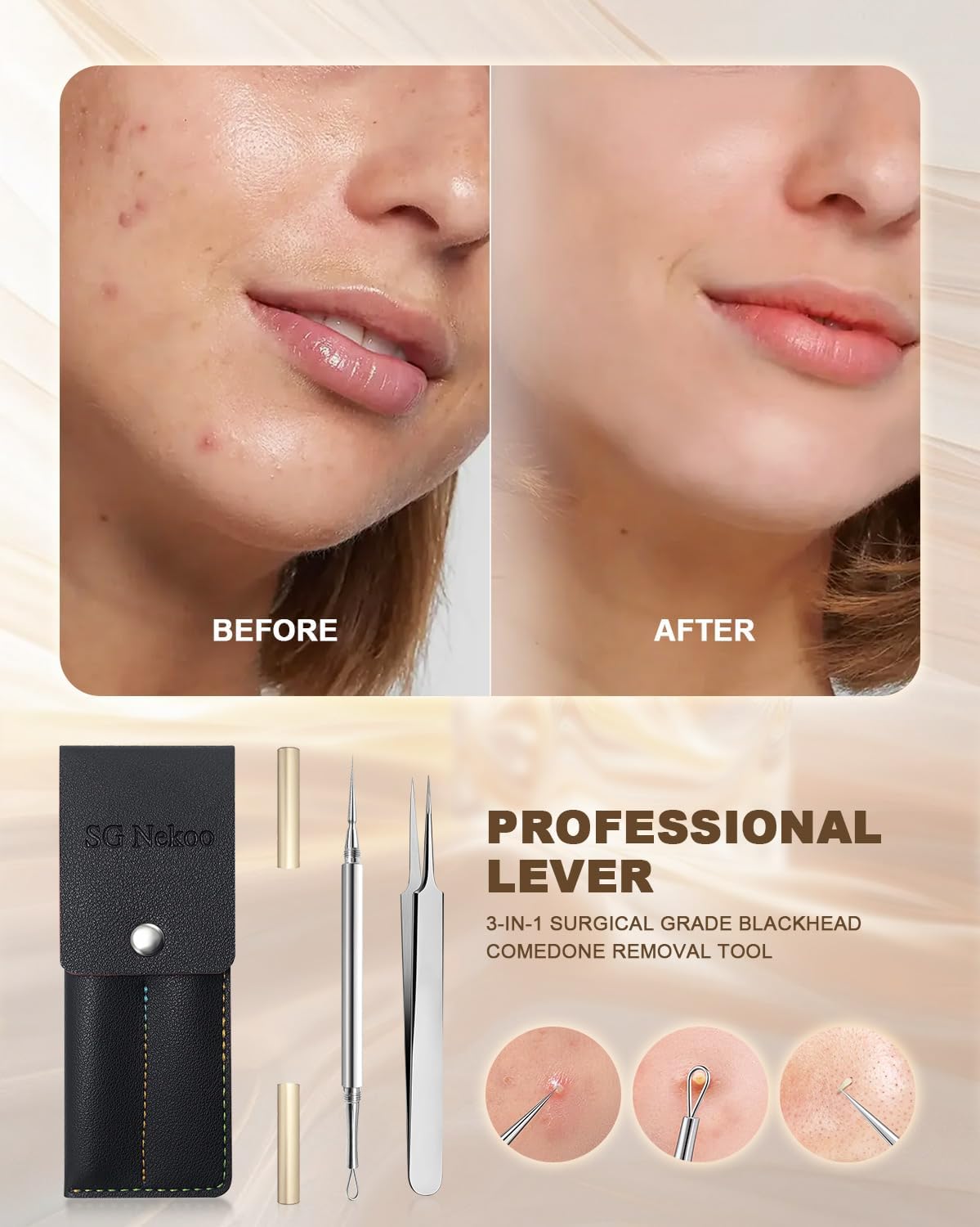 HERRAMIENTA PROFESIONAL PARA EXTRACCIÓN FACIAL SGNEKOO MILIA Y PUNTOS BLANCOS - 2