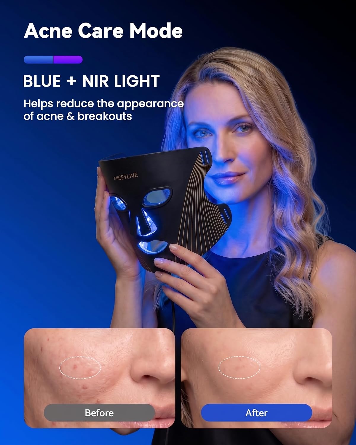 TERAPIA DE LUZ AZUL PARA ACNÉ MICEYLIVE FDA - 3
