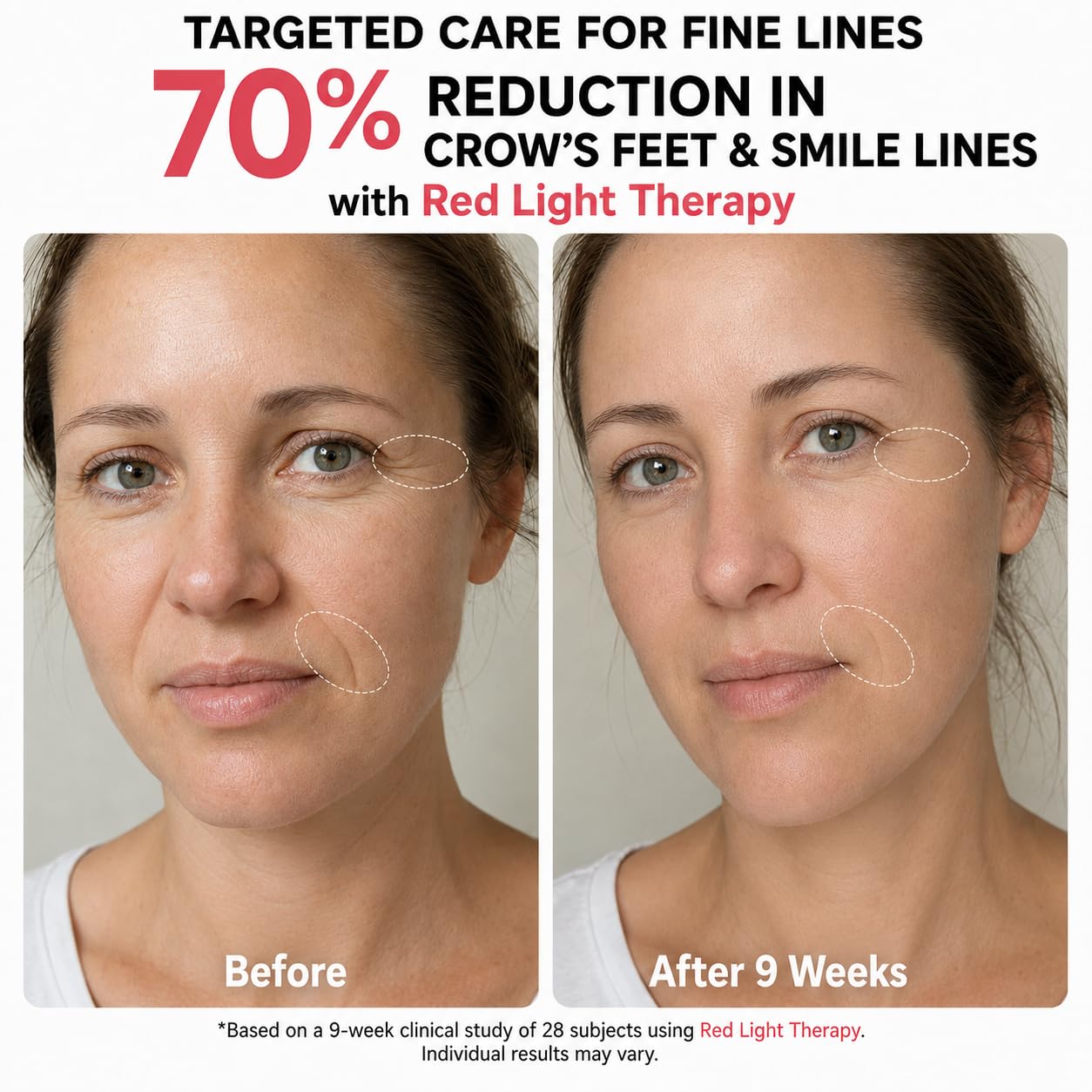 MASCARILLA FACIAL MICEYLIVE TERAPIA DE LUZ ROJA Y AZUL 432 LED - 4