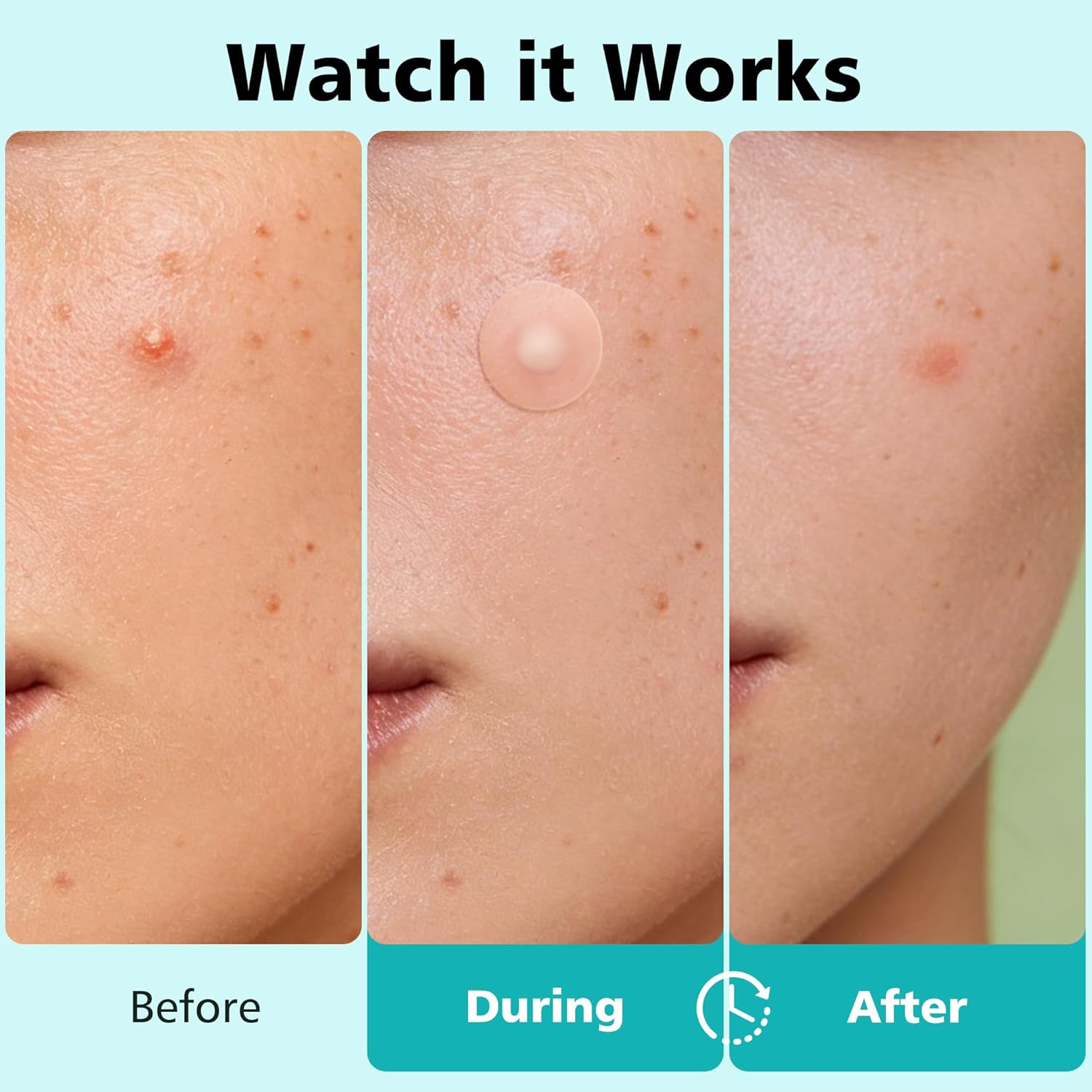 600 PARCHES ACNE COLOR PIEL CON ACIDO SALICILICO DR PATCH - 4