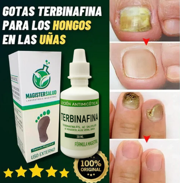 TERBINAFINA GOTAS ANTIFÚNGICAS