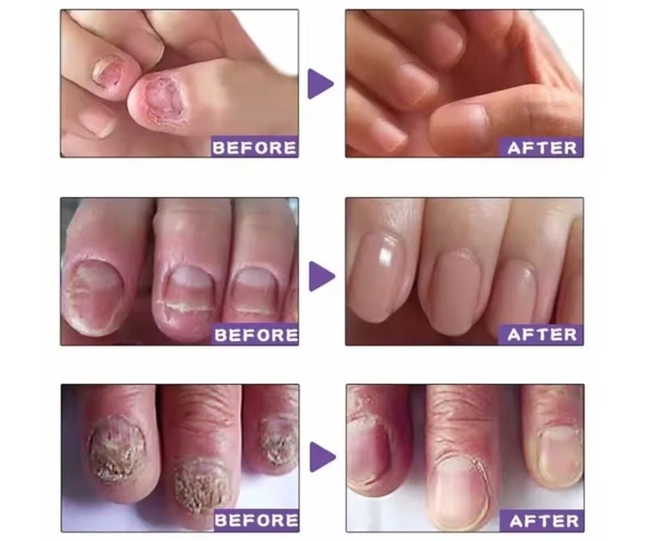 GEL PARA TRATAMIENTO DE UÑAS CON HONGOS. - 4