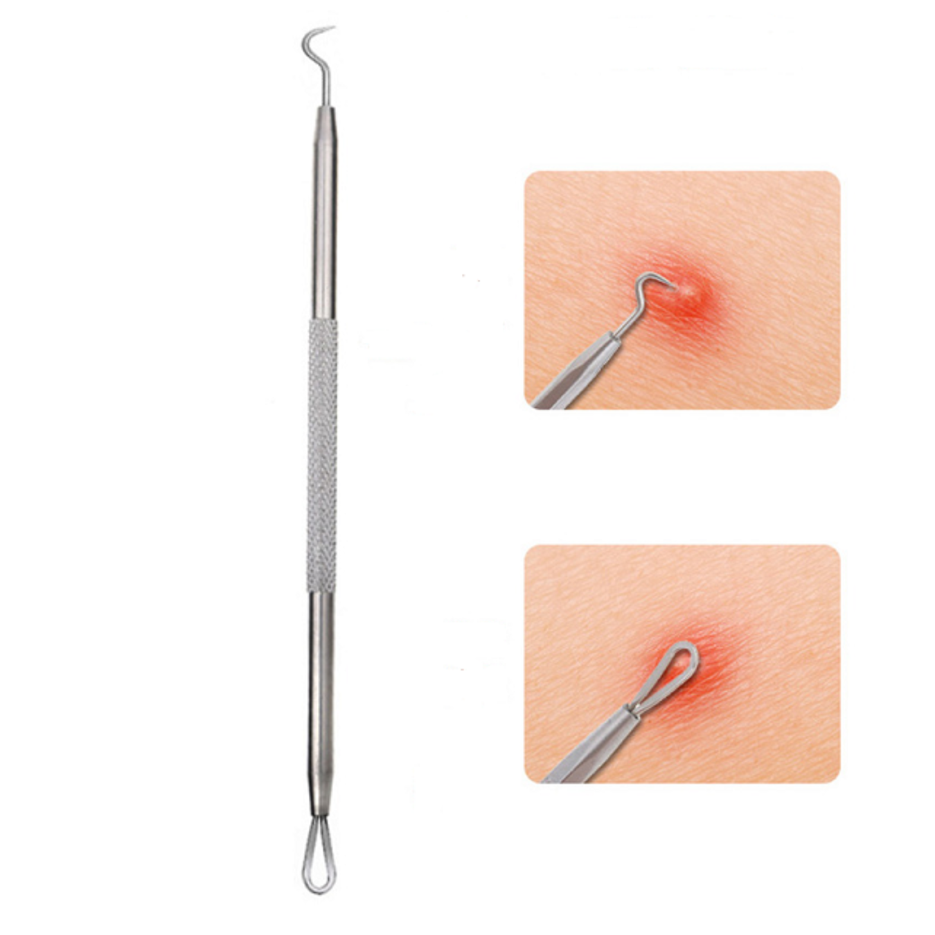 EXTRACTOR PUNTOS NEGROS REMOVEDOR ESPINILLAS ACNE SACA COMEDONES ACERO INOXIDABLE SET 5 PIEZAS - 6