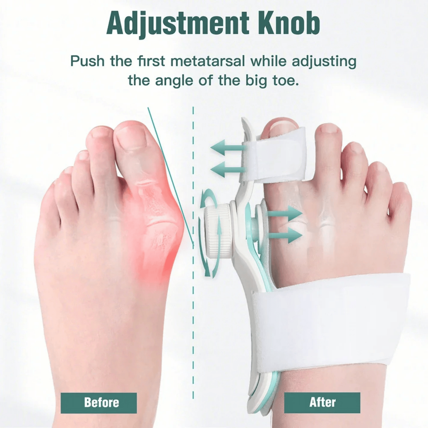 CORRECTOR JUANETE HALLUX VALGUS PLACAS FIJACIÓN 3 ÁNGULOS - 4