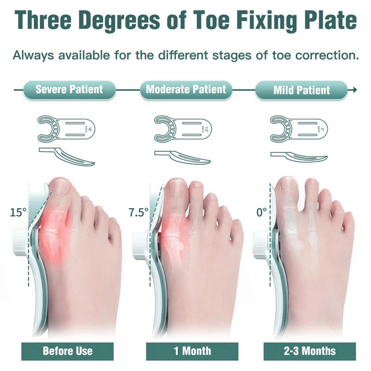 CORRECTOR JUANETE HALLUX VALGUS PLACAS FIJACIÓN 3 ÁNGULOS - 5