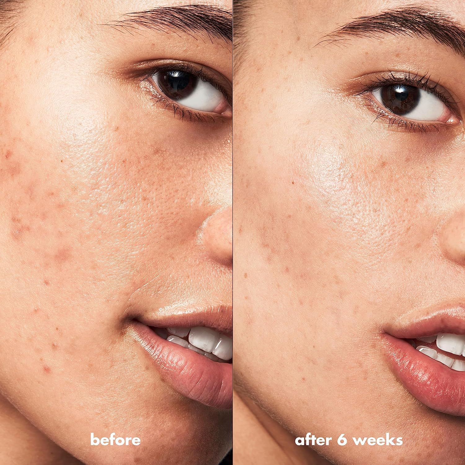 E.L.F. SKIN BLEMISH BREAKTHROUGH - GEL PARA COMBATIR EL ACNÉ, ROLL-ON PARA TRATAR IMPERFECCIONES - 5