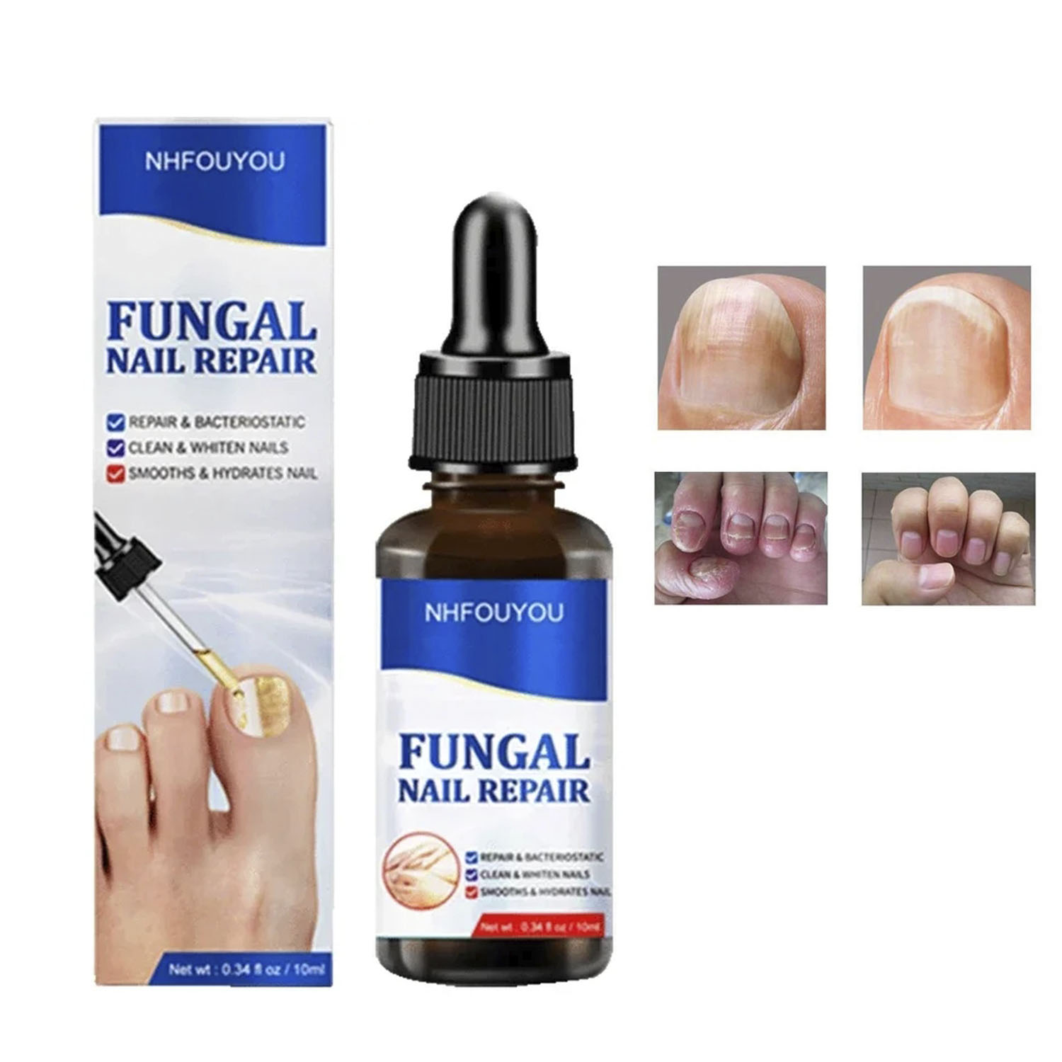 TRATAMIENTO EFICAZ PARA HONGOS EN UÑAS - PIES Y MANOS - 1