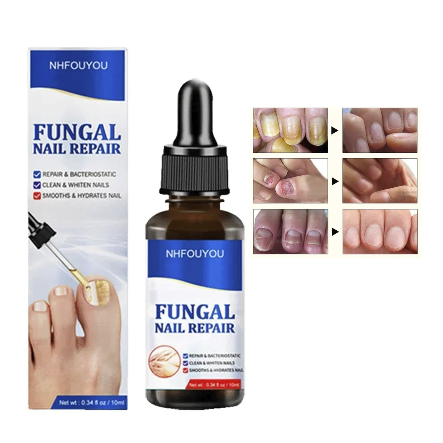 TRATAMIENTO EFICAZ PARA HONGOS EN UÑAS - PIES Y MANOS - 3