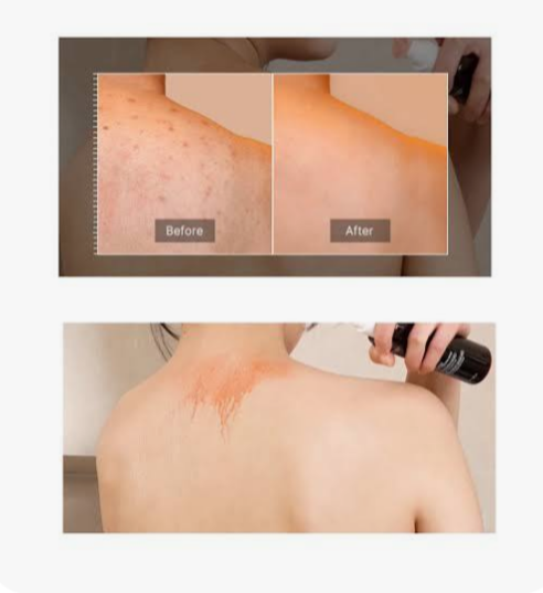 MEDICUBE RED ACNE BODY PEELING SHOT 110GR - 5