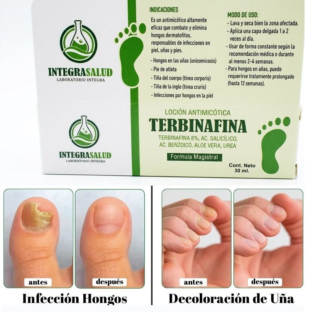 2 TERBINAFINA S 8% EN GOTAS PARA TRATAMIENTO  DE HONGOS EN LAS UÑAS Y PIES - 2