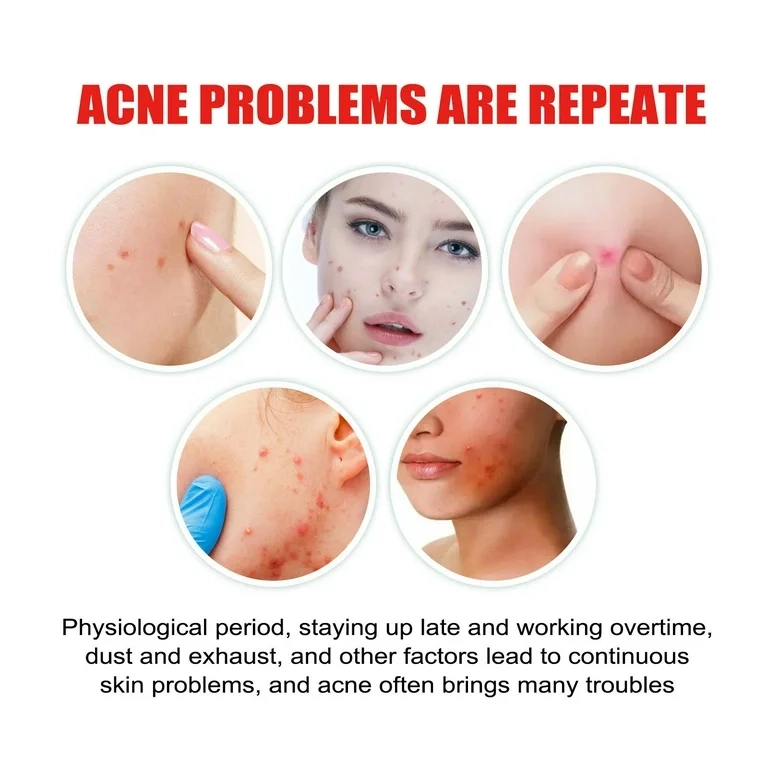 PARCHES ANTI GRANOS HIDROCOLOIDE ESPINILLAS TRATAMIENTO ANTIACNE 200 UNIDADES - 3