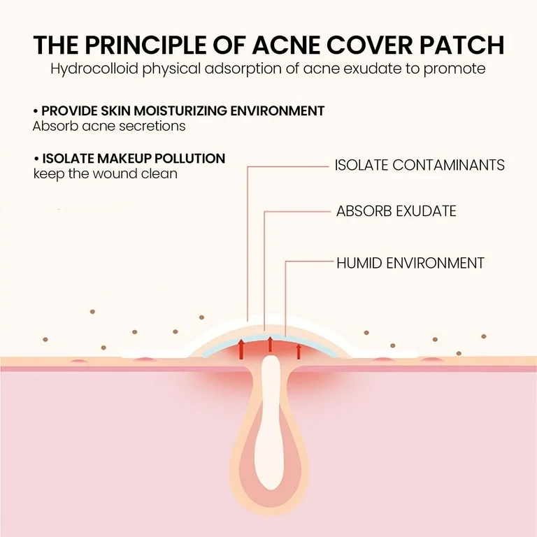PARCHES ANTI GRANOS HIDROCOLOIDE ESPINILLAS TRATAMIENTO ANTIACNE 200 UNIDADES - 5