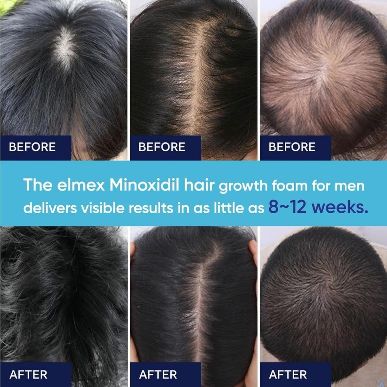 ESPUMA DE MINOXIDIL AL 5% PARA HOMBRES Y MUJERES - PACK 3X60G - 6