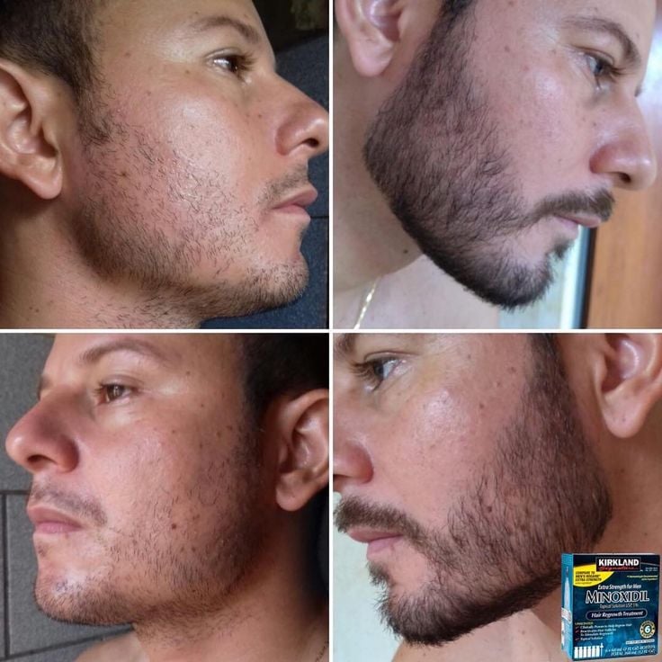 MINOXIDIL LIQUIDO KIRKLAND 60 ML CON GOTERO PARA BARBA CABELLO Y CEJAS - 3